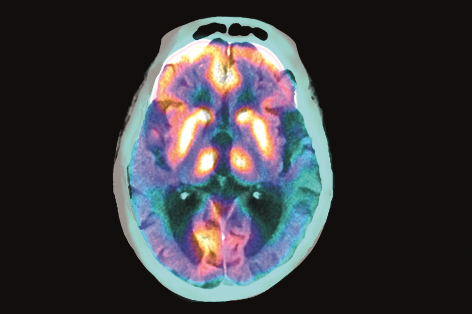 PET scan, alzheimers disease brain scan