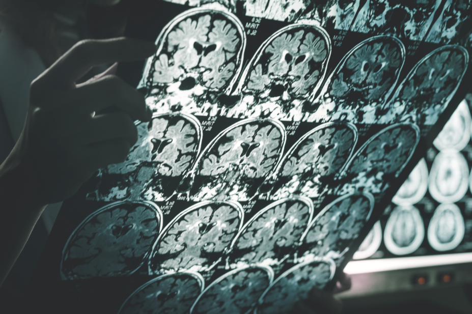 MRI scan of brain showing Alzheimer's disease