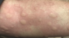 anaphylaxis skin reaction