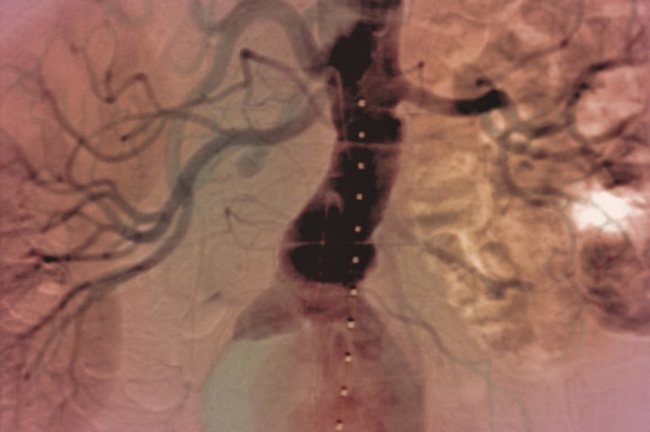 Researchers have found that fluoroquinolone use is also associated with an increased risk of aortic aneurysm. In the image, x-ray of an aortic aneurysm