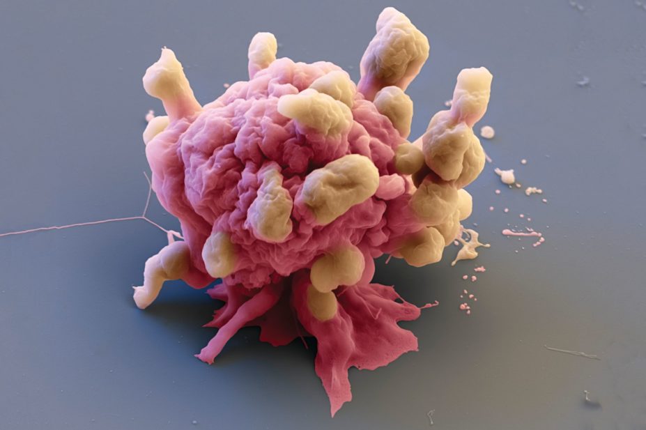 Scanning electron micrograph of a dying cancer cell