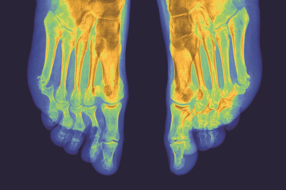 Biosimilar infliximab is now available for the management of a number of rheumatology conditions and, in the next few years, additional biosimilar medicines will become available for rheumatology patients. In the image, x-ray of arthritic feet