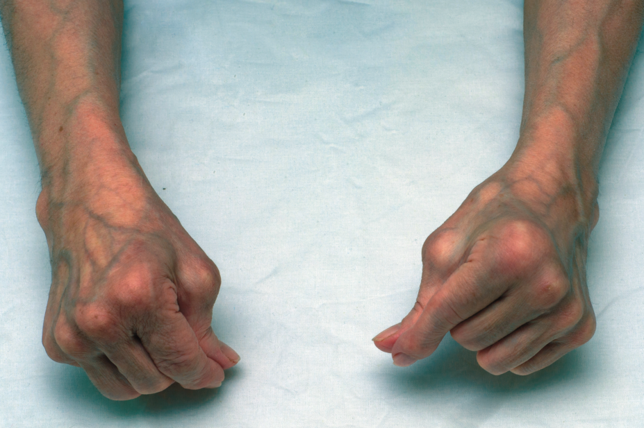 Arthritic hands of an older patient