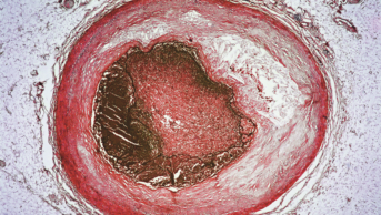 Micrograph of the section of a coronary artery with atherosclerosis and thrombosis