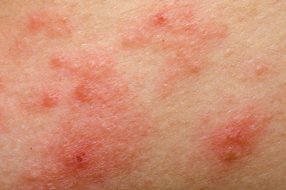 Close up of skin with atopic dermatitis