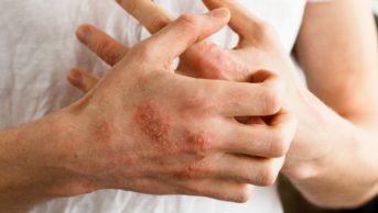 Atopic dermatitis on hands