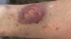 Corticosteroid creams can cause side effects, ranging from a slight burning sensation to a thinning of the skin (pictured). Spironolactone, a diuretic used to treat oedema can reduce side effects from corticosteroid-based creams, according to new research