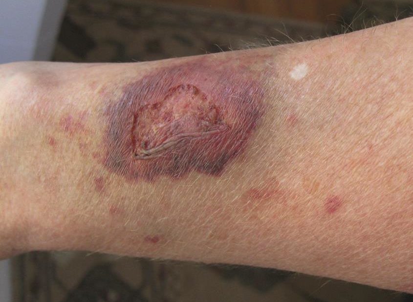 Corticosteroid creams can cause side effects, ranging from a slight burning sensation to a thinning of the skin (pictured). Spironolactone, a diuretic used to treat oedema can reduce side effects from corticosteroid-based creams, according to new research