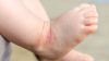 Baby's foot with eczema