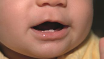 Identifying symptoms associated with primary tooth eruption (pictured), the available treatments and best practice for management