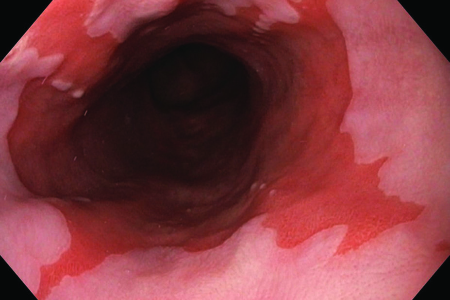Endoscopic view showing Barrett's oesophagus