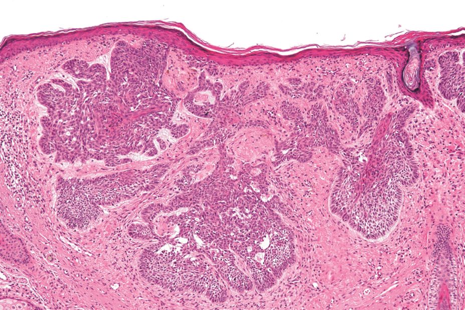 The US Food and Drug Administration has approved sonidegib (Novartis’s Odomzo) as a treatment for patients with locally advanced basal cell carcinoma (micrograph pictured) that has recurred following surgery or radiation therapy