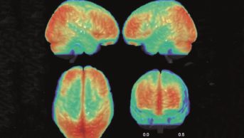 Bipolar brain, 3D view of an MRI scan