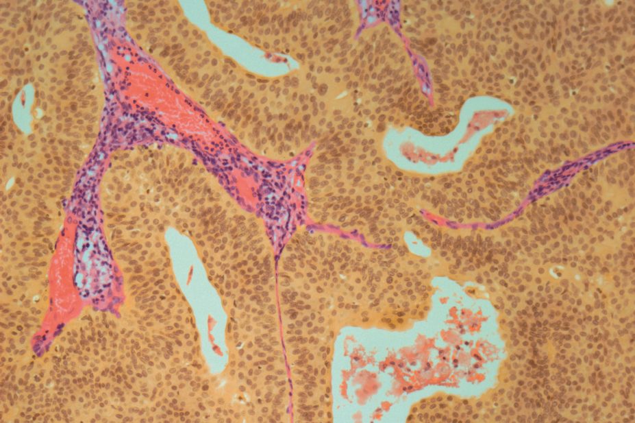Immune checkpoint inhibitor shows positive results in bladder cancer (pictured, light micrograph)