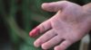 haemophilia-bleeding-finger