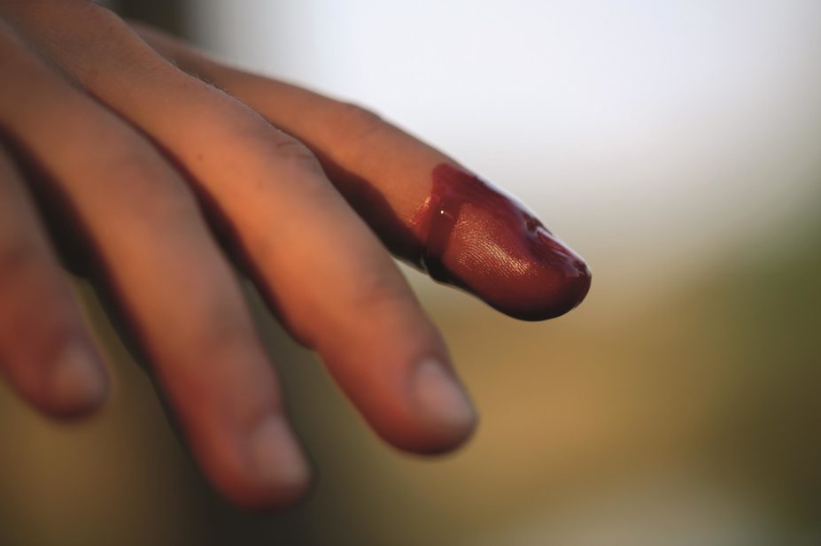 The European Medicines Agency is recommending that human coagulation factor X (Coagadex) is authorised to treat the rare bleeding disorder factor X deficiency. Pictured, a bleeding hand.
