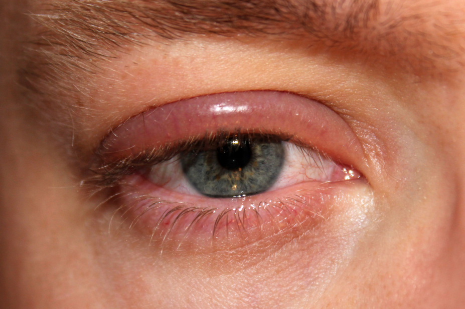 blepharitis inflammation eyelid wi 17