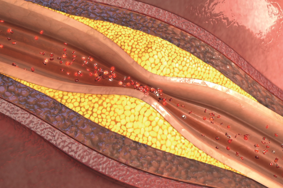 Illustration of a blocked artery