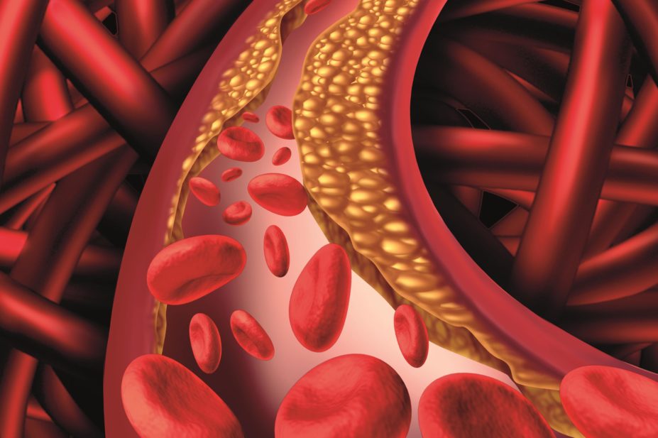 blood-clot-artery-lipid-heart-attack-15