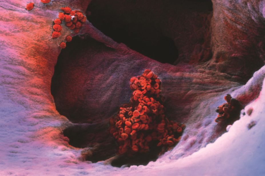 Idarucizumab, a unique drug which can neutralise the effect of the anticoagulant dabigatran etexilate, is being recommended for marketing authorisation across the EU. In the image, micrograph of a blood clot in the heart