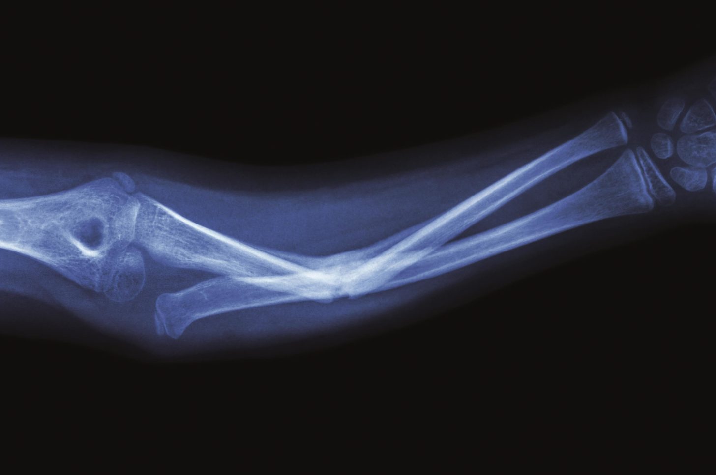 FDA strengthens fracture warnings for canagliflozin - The ...