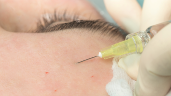 Close up of woman receiving botox injection