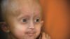 Researchers found that methylene blue, a chemical which has antioxidant effects in mitochondria, can rescue mitochondrial defects in both progeria and normal skin cells. In the image, close up of Beandri Booysen, who suffers from progeria