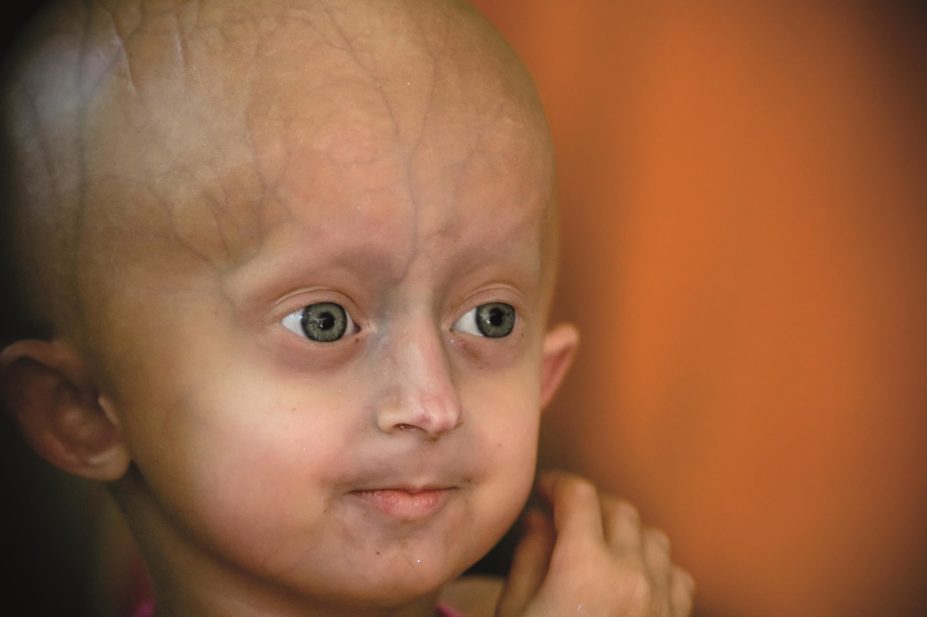 Researchers found that methylene blue, a chemical which has antioxidant effects in mitochondria, can rescue mitochondrial defects in both progeria and normal skin cells. In the image, close up of Beandri Booysen, who suffers from progeria