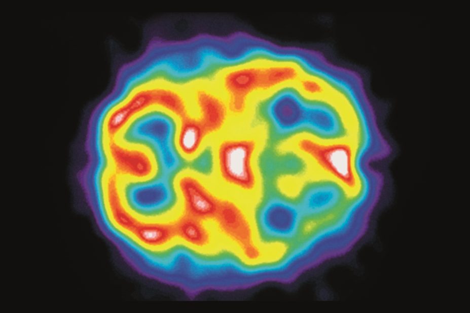 5HT1 receptor agonists (triptans) are used to treat acute migraine attacks. Despite their widespread use, clinically relevant interactions with 5HT1 receptor agonists are not frequently encountered. In the image, SPECT scan of a brain during a migraine