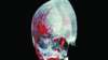 3D scan showing brain haemorrhage stroke