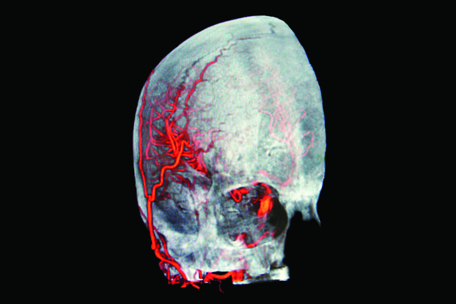 3D scan showing brain haemorrhage stroke