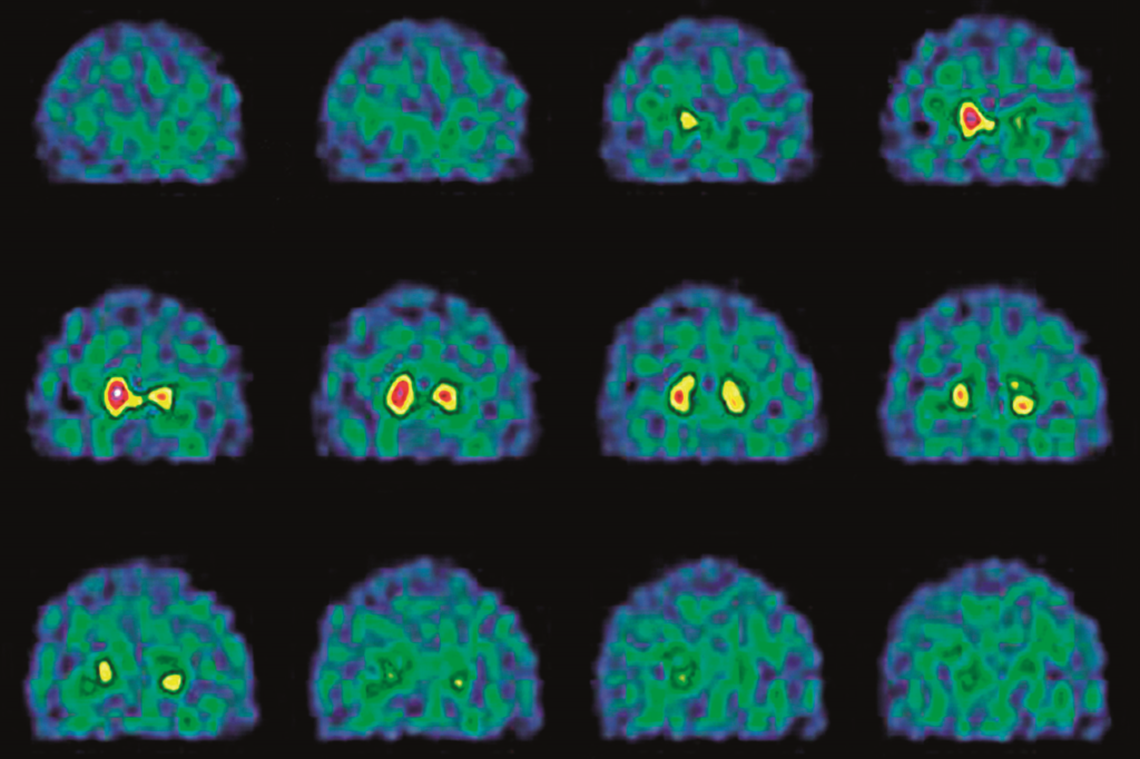Health Coaching With Ai For Parkinson'S Disease Management photo