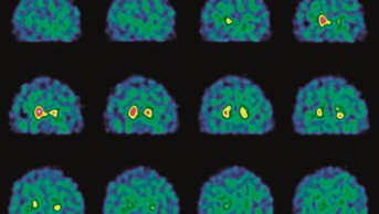 Brain activity in Parkinson's disease, SPECT scans