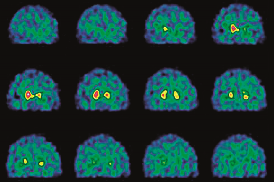 Brain activity in Parkinson's disease, SPECT scans