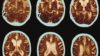Brain scan showing Alzheimer's disease