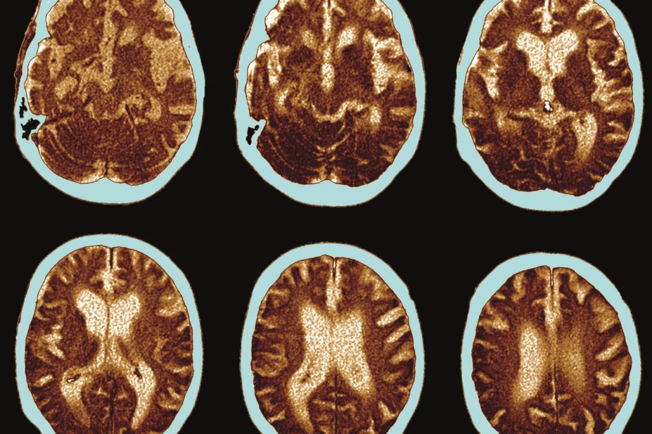 Brain scan showing Alzheimer's disease