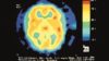 Brain scan showing migraine