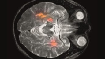 MRI scan showing multiple sclerosis