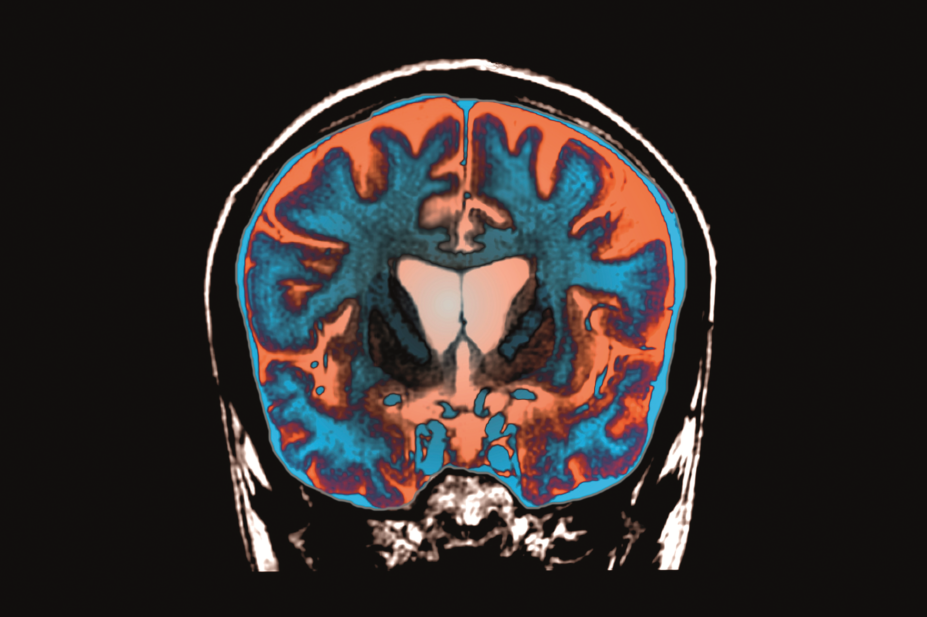MRI scan of brain with Huntington's disease