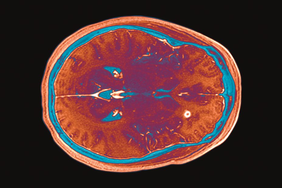 MRI scan of brain with multiple sclerosis (MS)