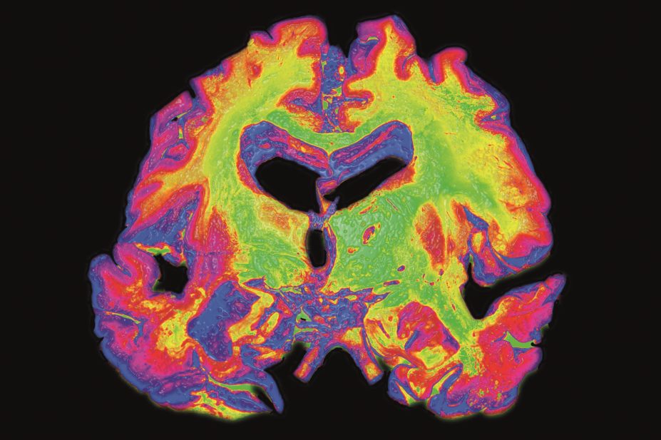 Colour enhanced coronal (frontal) section of a human brain specimen showing evidence of severe, advanced Alzheimer's disease