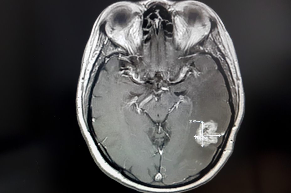 Human brain scan showing tumour