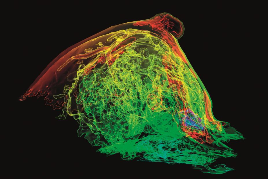 3D MRI scan of a breast with breast cancer