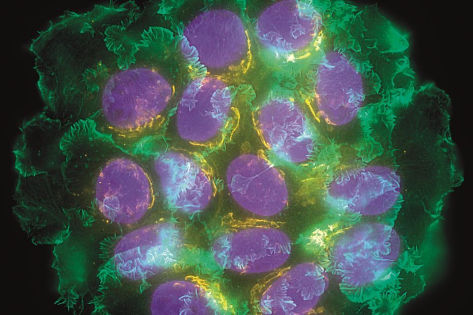 US researchers test paclitaxel plus trastuzumab in node-negative HER2-positive breast cancer. In the image, light micrograph of breast cancer cells