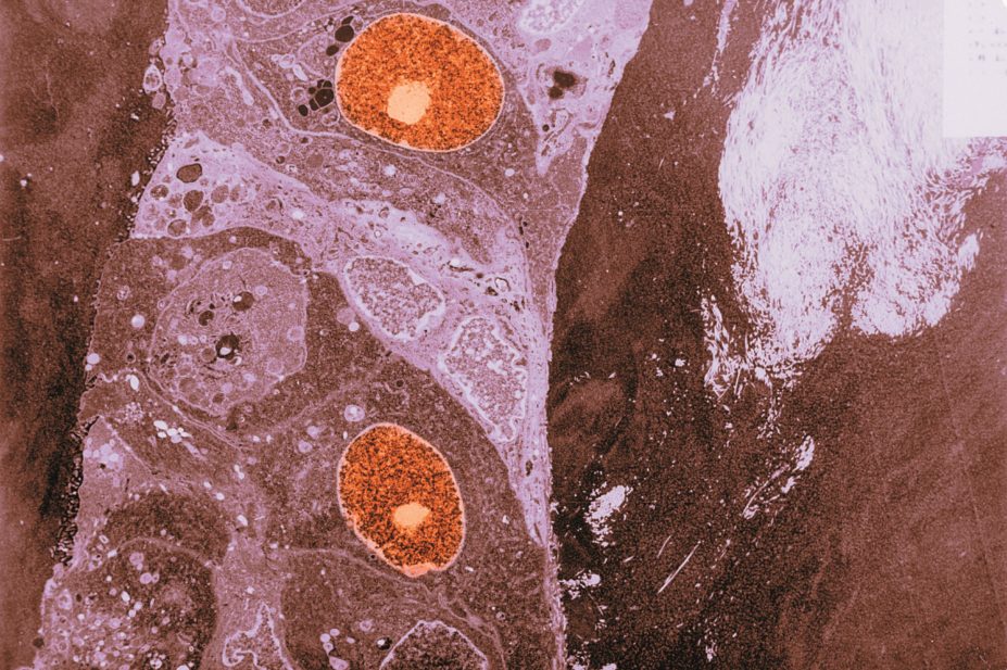 The US Food and Drug Administration has approved palbociclib (Ibrance, Pfizer) for advanced (metastatic) breast cancer in postmenopausal women under its accelerated approval programme. In the image, micrograph of breast cancer cells
