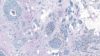 Micrograph of breast cancer cells