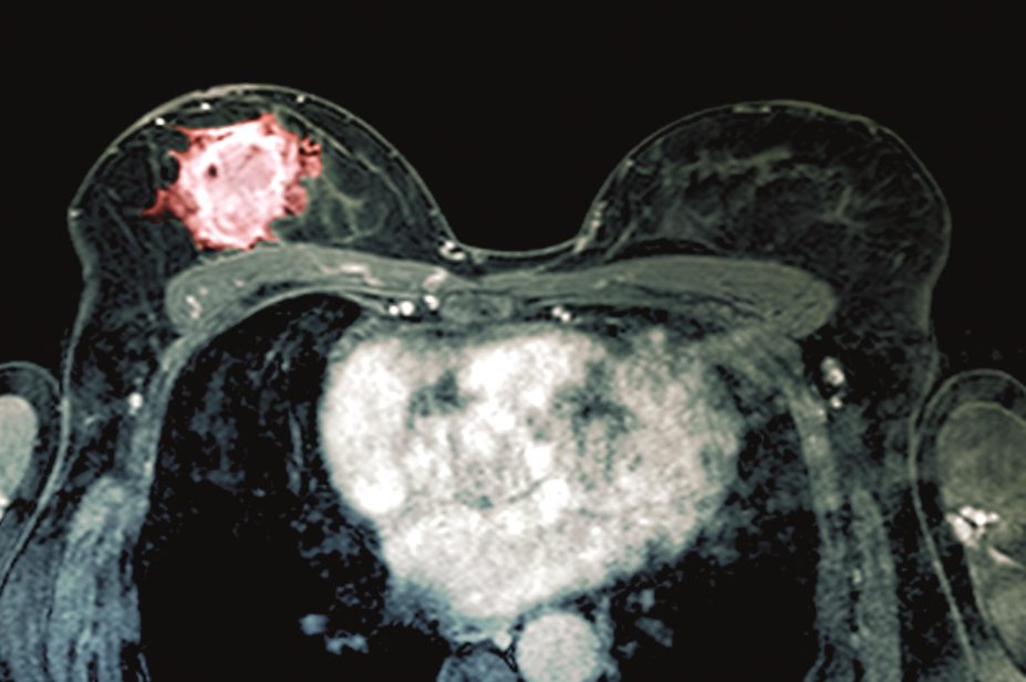 A scan of cancerous breast tissue