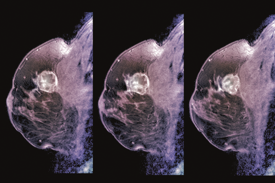 Three MRI scans showing breast cancer