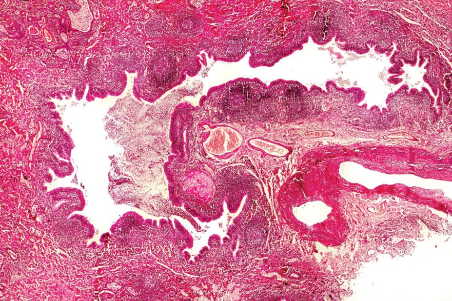 Bronchiectasis, light photomicrograph showing dilated and distorted bronchus containing pus