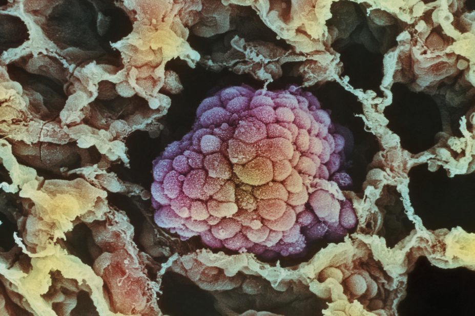 The UK’s medicines safety watchdog has given nivolumab a positive scientific opinion under the EAMS as a treatment for lung cancer (NSCLC) after prior chemotherapy in adults. In the image, micrograph of a cancerous tumour in the lung